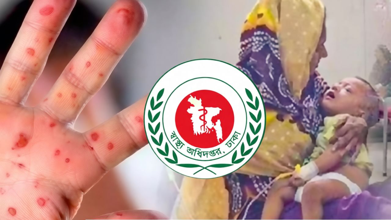 সিলেটে হামের থাবায় আরও ৩ শিশুর মৃত্যু