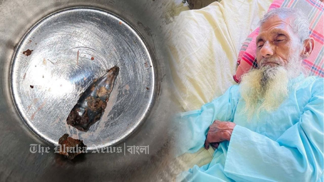 মুক্তিযুদ্ধের সময়ের গুলি ৫৫ বছর পর শরীর থেকে অপসারণ